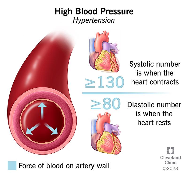 HYPERTENSION (HIGH BLOOD PRESSURE)